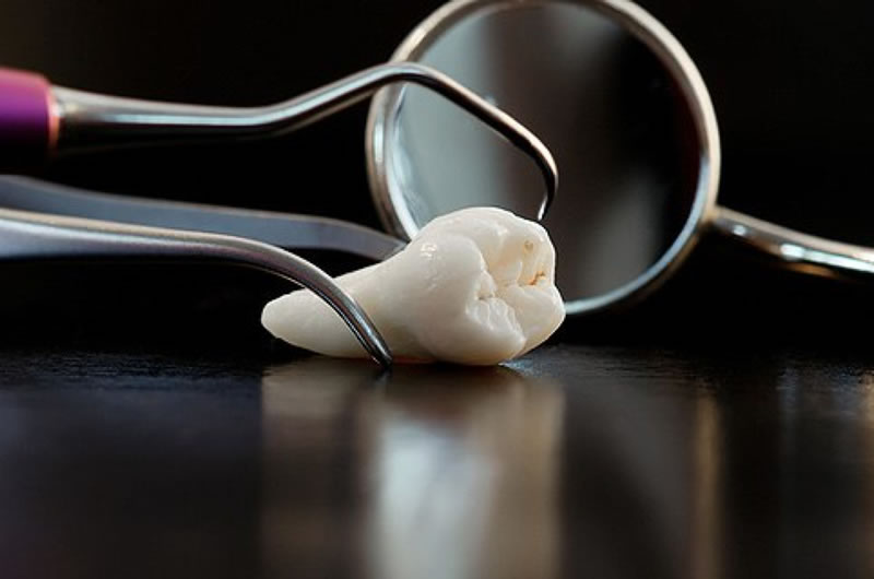 tooth extraction tooth extraction