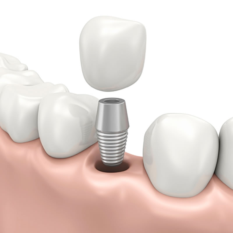 Dental Implants Dental Implants