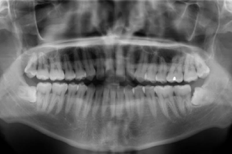 DIGITAL X-RAYS DIGITAL X-RAYS